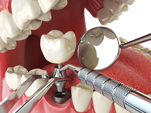 Best Emergency Tooth Extraction in Lincoln, AR